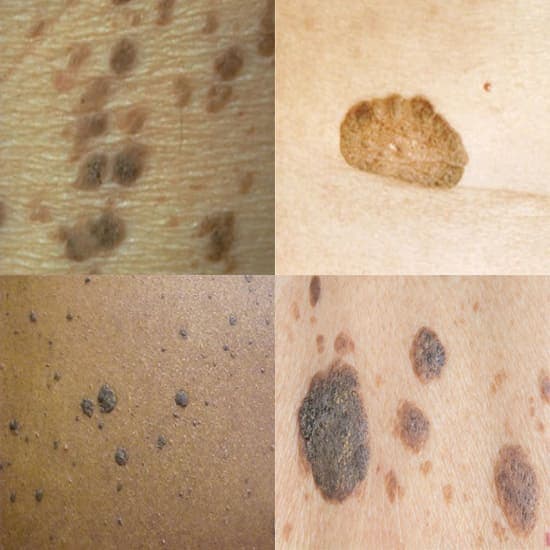 Seborrheic Keratosis